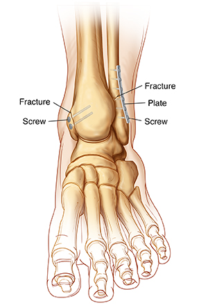 Front view of ankle and foot bones showing ankle fractures with internal fixation using screws and a plate.