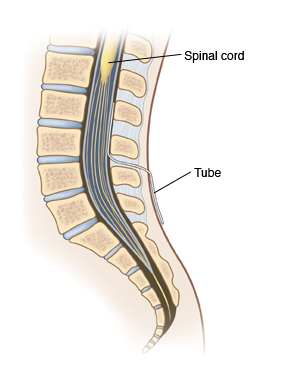 Side view cross section of lower spine showing tube inserted into spinal canal.