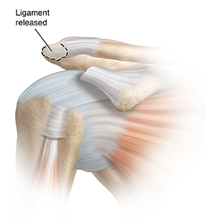 Front view of shoulder joint showing tendon released and bone to be removed.