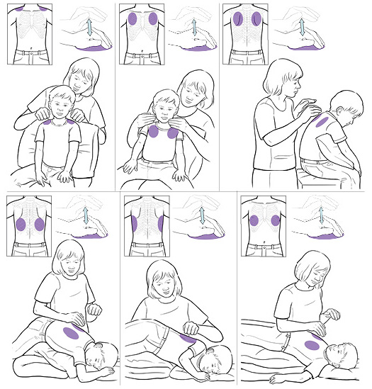 Cómo hacer percusiones torácicas para ayudar a que salga la mucosidad de los pulmones de un niño.