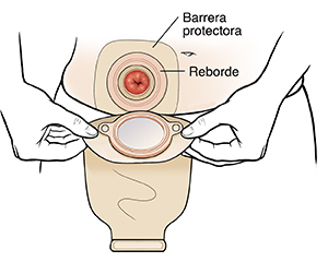 Manos colocando la bolsa de ostomía sobre el estoma.